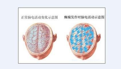 脑电图异常就是癫痫病吗