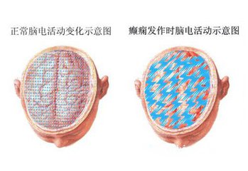 什么是原发性癫痫病